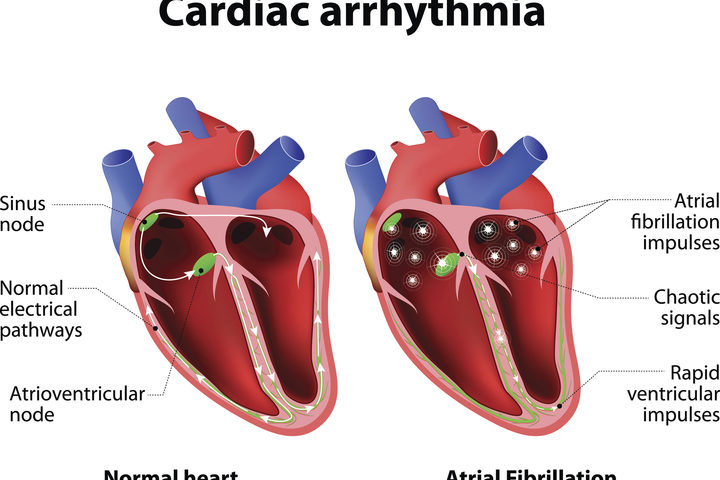 Scompenso cardiaco